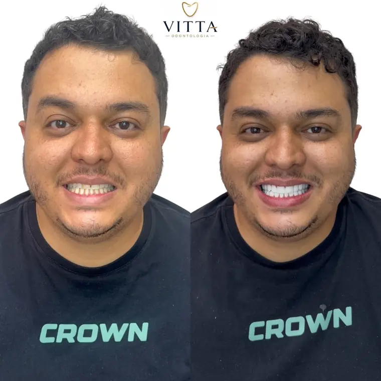 Antes e depois de lentes de resina, paciente da Vitta